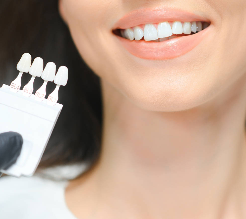 Carillas dentales en Medellín: Guía completa para transformar tu sonrisa