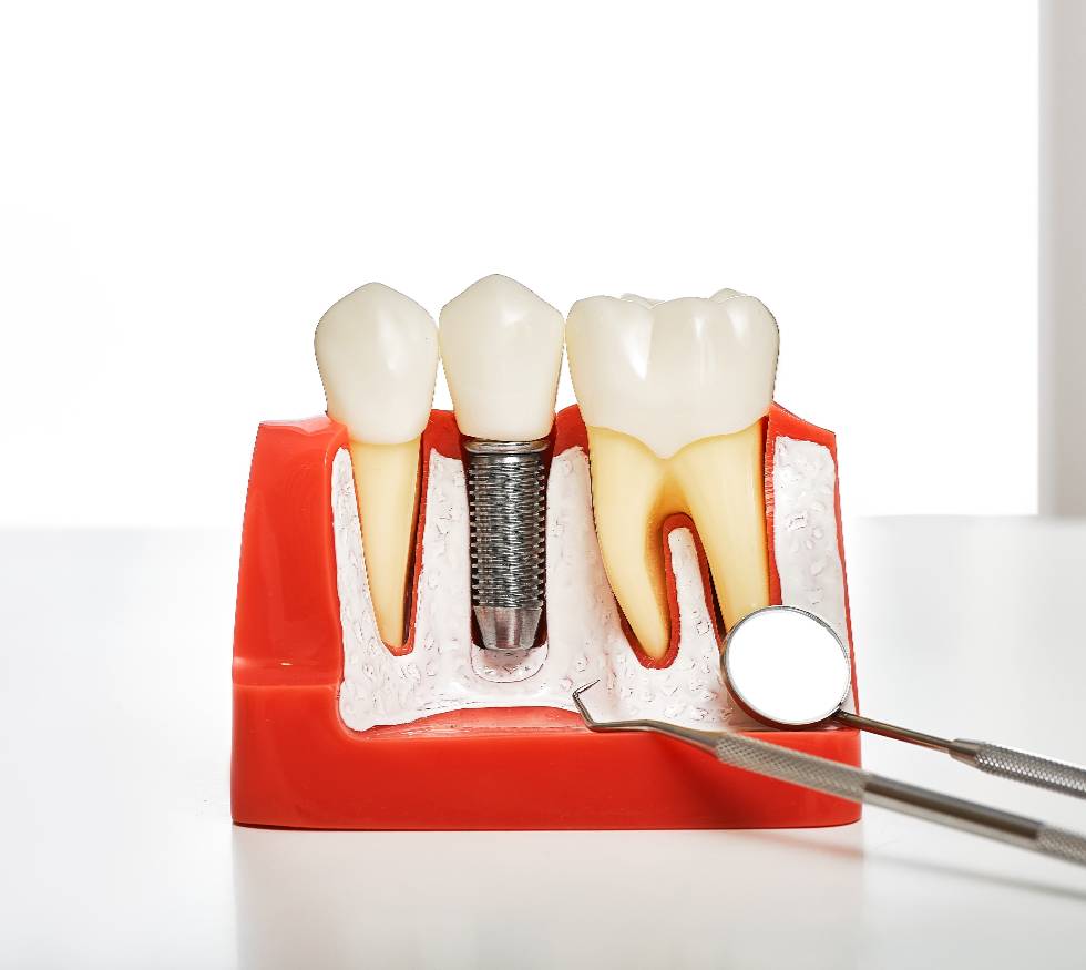 Implantes dentales: recupera tu sonrisa con soluciones duraderas