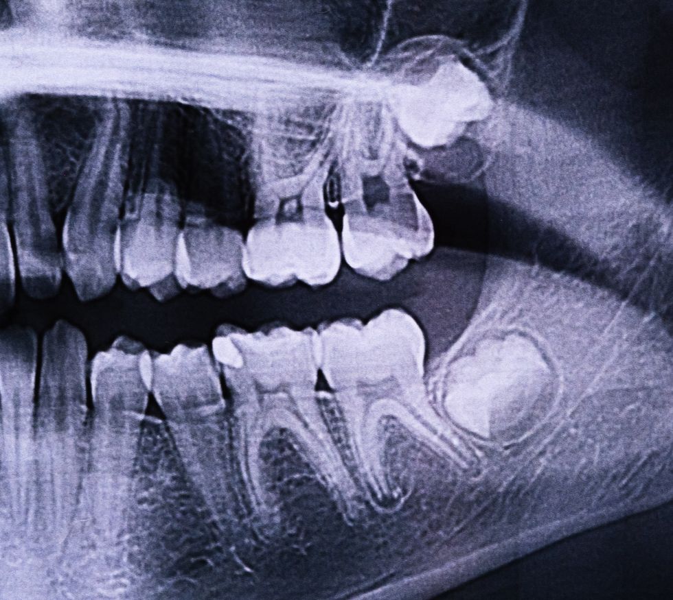 Extracción de cordales: cuándo es realmente necesaria y cómo es la recuperación