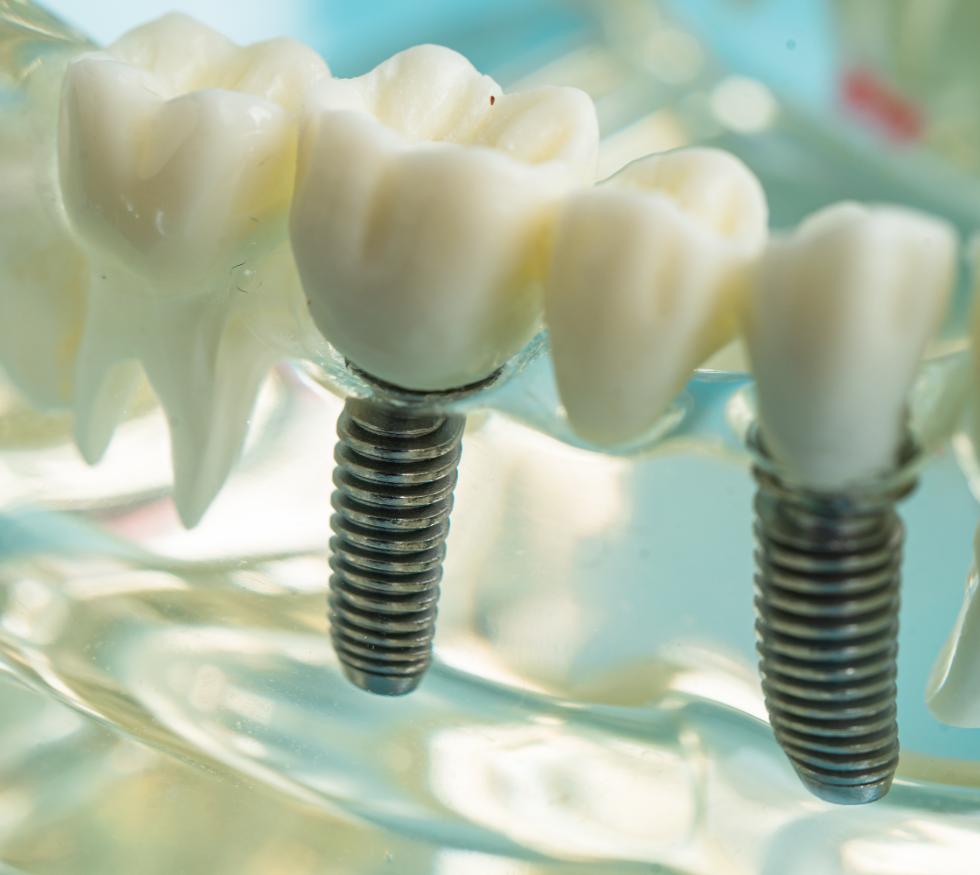 Implantes dentales: cuándo son la mejor opción y cómo es el proceso real