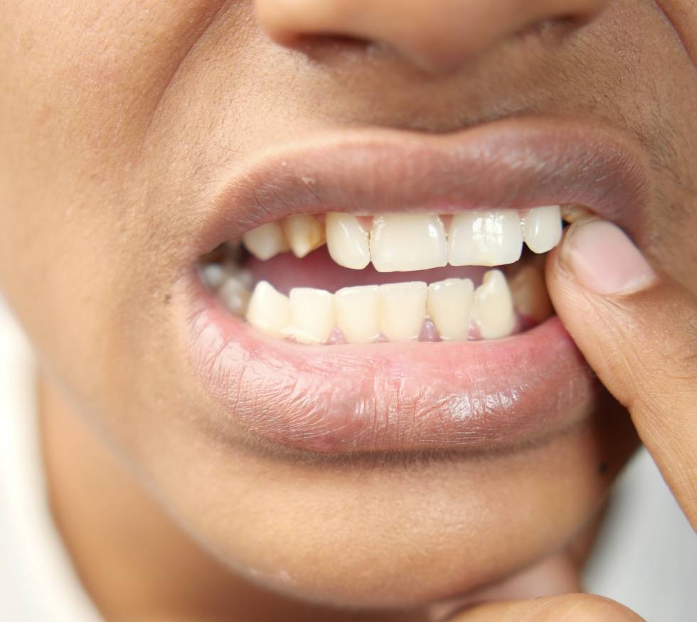 ¿Por qué se aflojan los dientes en adultos?