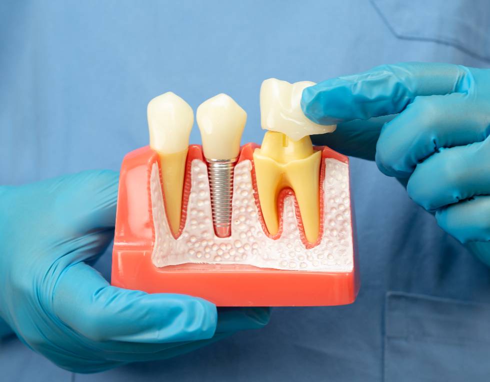 ¿Se te cayó una corona o una resina? Qué hacer mientras visitas al odontólogo.