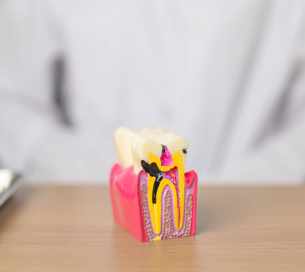 ¿Qué es una endodoncia y cuándo se necesita?