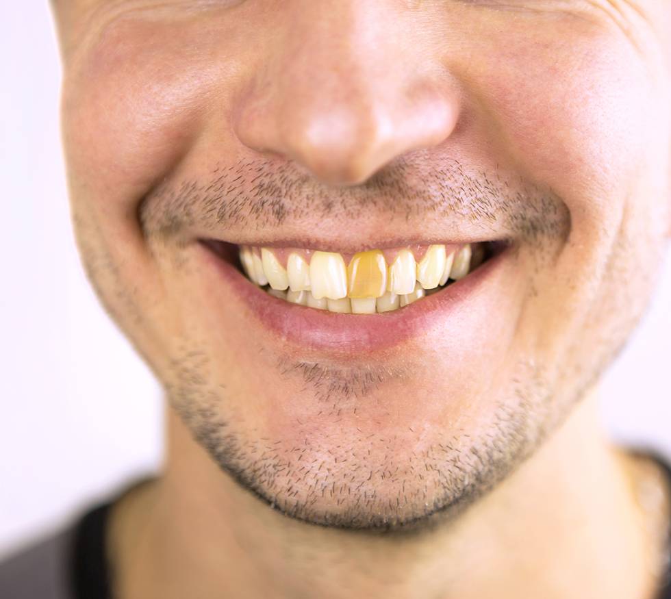 ¿Por qué algunos dientes cambian de color con el tiempo?