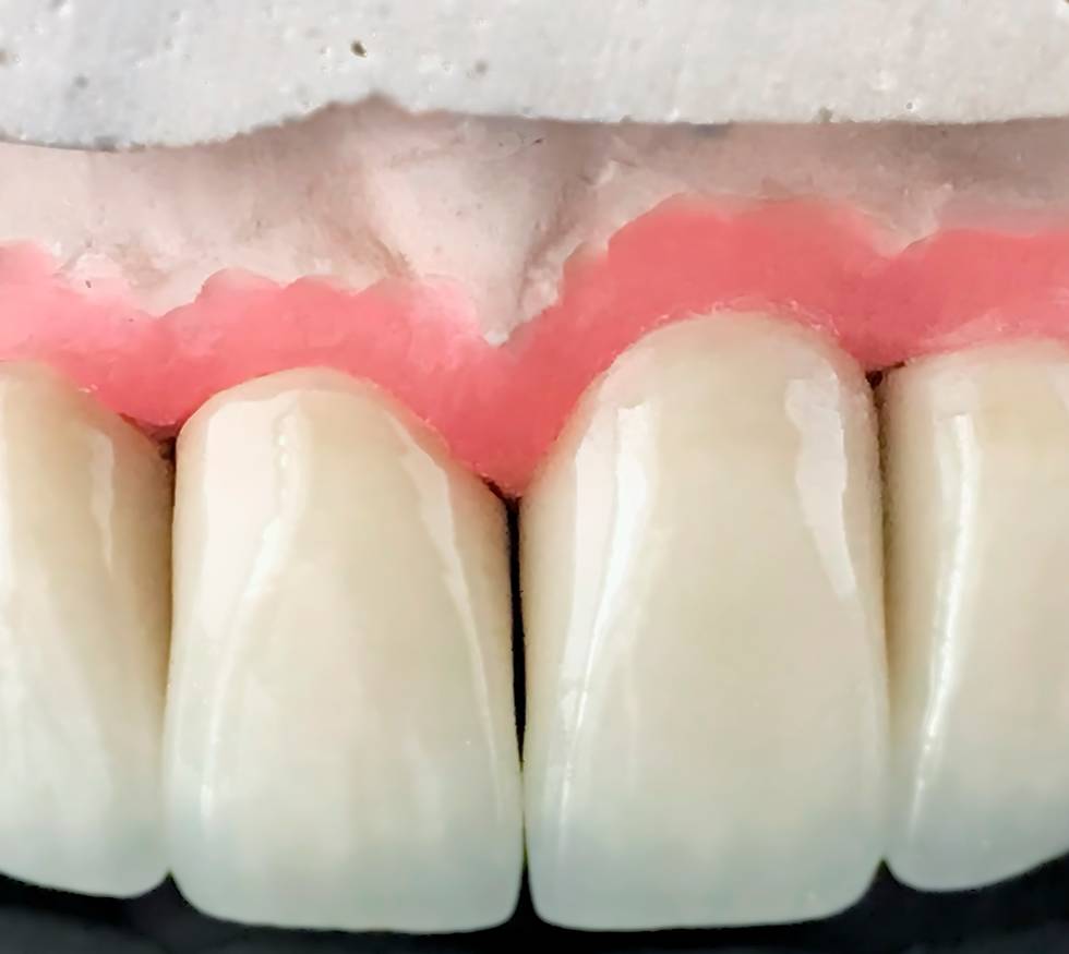 ¿Qué es la periodontitis y cómo se trata?