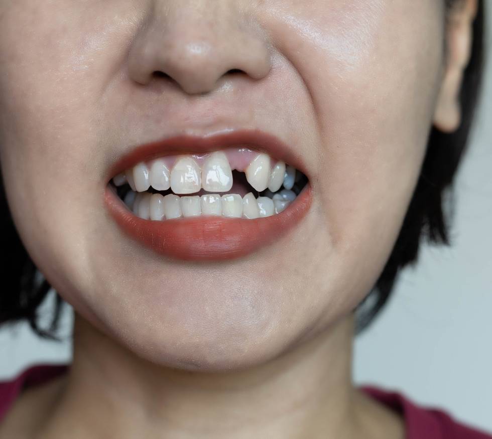¿Qué opciones existen para reemplazar dientes perdidos?