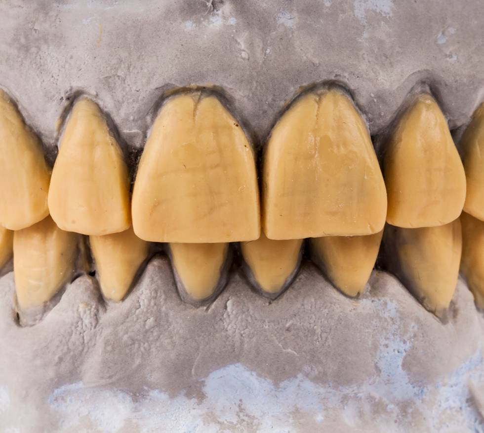 Tratamientos para recuperar dientes desgastados